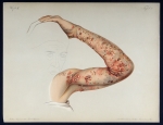 Pemphigus pruriginosus - Atlas der Hautkrankheiten