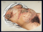 Impetigo herpetiformis - Atlas der Hautkrankheiten