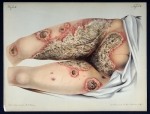 Impetigo herpetiformis - Atlas der Hautkrankheiten