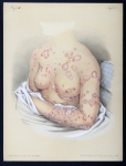Psoriasis orbicularis - Atlas der Hautkrankheiten