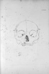 Pl. LXXVIII. Crâne de la fille Bouhours, avec un très-grand développement des organes qui disposent  [...]