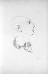 Pl. XX. Fig. 1 et 2. Tête et crâne d'une fille de vingt ans complètement imbécile - Anatomie et phys [...]