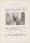 Deux chancres vulvaires juxtaposés - Le musée de l'hôpital Saint-Louis : iconographie des maladies c [...]