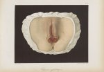 Chancres syphilitiques - Le musée de l'hôpital Saint-Louis : iconographie des maladies cutanées et s [...]