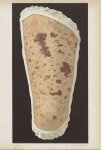 Erythème purpuriave en plaques à poussées successives - Le musée de l'hôpital Saint-Louis : iconogra [...]