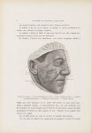 Lupus erythémateux - Le musée de l'hôpital Saint-Louis : iconographie des maladies cutanées et syphi [...]