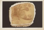 Dermatite herpétiforme en cocarde - Le musée de l'hôpital Saint-Louis : iconographie des maladies cu [...]