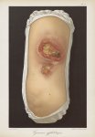 Gommes syphilitiques - Le musée de l'hôpital Saint-Louis : iconographie des maladies cutanées et syp [...]