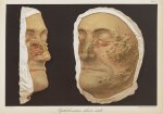 Epitheliomatose sébacée sénile - Le musée de l'hôpital Saint-Louis : iconographie des maladies cutan [...]