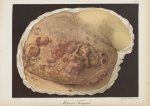 Mycosis fongoïde - Le musée de l'hôpital Saint-Louis : iconographie des maladies cutanées et syphili [...]