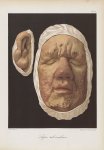 Lèpre tuberculeuse - Le musée de l'hôpital Saint-Louis : iconographie des maladies cutanées et syphi [...]