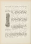 Fig. I. Bourrelet en demi-cercle formé par une tumeur à la jambe droite d'un malade atteint de mycos [...]