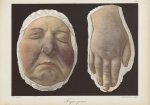 Lupus pernio - Le musée de l'hôpital Saint-Louis : iconographie des maladies cutanées et syphilitiqu [...]