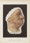 Syphilide papulo-tuberculeuse - Le musée de l'hôpital Saint-Louis : iconographie des maladies cutané [...]