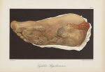 Syphilide hyperkératosante - Le musée de l'hôpital Saint-Louis : iconographie des maladies cutanées  [...]