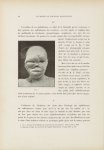 Fig. 3. [Epithéliome] - Le musée de l'hôpital Saint-Louis : iconographie des maladies cutanées et sy [...]