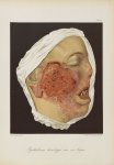 Epithéliome développé sur un lupus - Le musée de l'hôpital Saint-Louis : iconographie des maladies c [...]