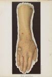 Gale pustuleuse - Le musée de l'hôpital Saint-Louis : iconographie des maladies cutanées et syphilit [...]