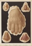 Lupus pernio-dactylites scrofulo-tuberculeuses - Le musée de l'hôpital Saint-Louis : iconographie de [...]