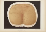Syphilide miliaire - Le musée de l'hôpital Saint-Louis : iconographie des maladies cutanées et syphi [...]