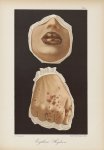 Erythème hydroa - Le musée de l'hôpital Saint-Louis : iconographie des maladies cutanées et syphilit [...]