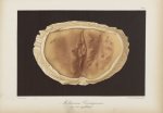 Molluscum contagiosum chez une syphilitique - Le musée de l'hôpital Saint-Louis : iconographie des m [...]