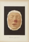 Xeroderma pigmentosum - Le musée de l'hôpital Saint-Louis : iconographie des maladies cutanées et sy [...]