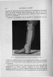 Fig. 42. Appareil de marche pour les fractures malléolaires. - Profil - Exposé des travaux scientifi [...]