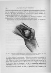 Fig. 65. Interposition musculo-fibreuse (pièce expérimentale) - Exposé des travaux scientifiques