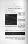 Fig. 37. Nombre, durée et forme de l'oscillation constitutive du tremblement dans la maladie de Park [...]