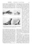 Fig. 3 et 4 - A gauche, photographie des moulages de la main et du pied pris par Lemolt sur Louschki [...]