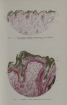 Fig. 2 - 1, couche cornée complètement imprégnée; 2, corps muqueux de Malpighi; 3, follicule pileux; [...]