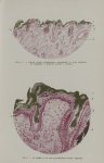 Fig. 2. - 1, couche cornée complètement imprégnée; 2, corps muqueux de Malpighi; 3, follicule pileux [...]