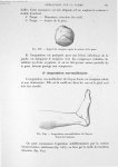 Fig. 538. Aspect du mignon après la suture de la peau/ Fig. 539. Amputation sus-malléolaire de Guyon [...]