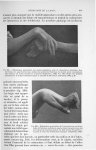 Fig. 301. Déformation particulière des mains semblable à celle du rhumatisme chronique, chez une fem [...]