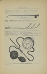 Fig. 15. - Sonde du Dr Boucheron; Fig. 16. - Sonde de Politzer ou d'Itard; Fig. 17. - Sonde palatomé [...]