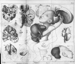 Hyperencéphale - Philosophie anatomique. Monstruosités humaines