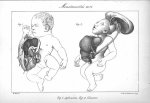 Planche VI. Monstruosités. Fig. 1. Agénosome / Fig. 2. Célosome - Histoire générale et particulière  [...]
