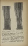 Fig. 130. Radiographie d'une fracture sus-malléolaire du tibia par torsion avec déplacement considér [...]