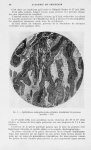 Fig. 1. — Epithélioma malpighien spino-cellulaire kératinisant du poumon (grossiss: 44 D) - Mémoires [...]