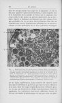 Fig. 1. — Dyskératose dans de la blastomycose végétante. Abcès intra-épidermique. On voit plusieurs  [...]
