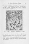 Fig. 12. — Oedème du corps muqueux de Malpighi et petit nid de cellules monocytoïdes intra-épidermiq [...]