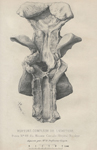 Rupture complète de l'urèthre Pièce N° 49 du musée civiale ; Hôpital Necker déposée par Mr le Profes [...]