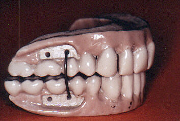 Une révolution en prothèse dentaire : Les dents artificielles minérales -  SFHAD