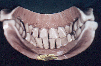 Les Dents Artificielles Sont En Céramique Pour Le Patient Banque D'Images  et Photos Libres De Droits. Image 183850258